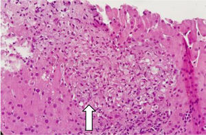 Biopsia de hígado con tinción de hematoxilina y eosina con aumento ×20 en donde aprecia la composición del granuloma no necrotizante (flecha blanca) compuesto por acúmulos de histiocitos y macrófagos rodeados de células epitelioides, compatibles con una hepatitis granulomatosa.