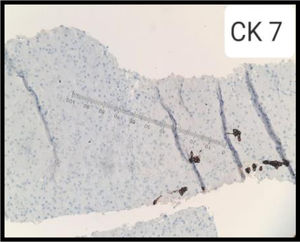 Biopsia de hígado con citoqueratina 7 (CK7) negativo en donde se evidencia integralidad de los ductos biliares a nivel del parénquima hepático.