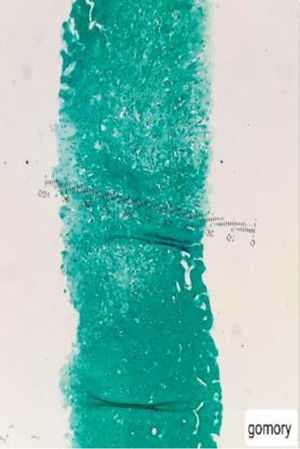 Tinción de Gomori en biopsia hepática la cual es negativa para infección por hongos.