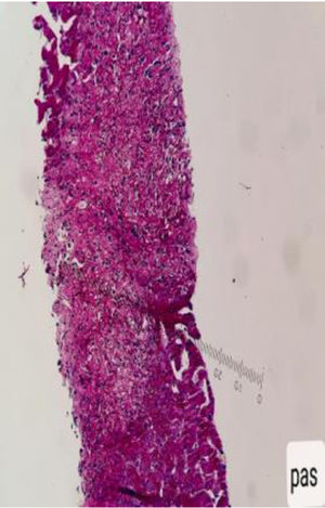 Tinción de ácido periódico de Schiff (PAS) en biopsia hepática la cual es negativa para infección por hongos.