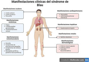 Manifestaciones clínicas del síndrome de Blau.