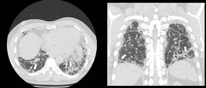 TACAR que demuestra reticulación subpleural, cambios fibrocicatriciales parenquimatosos, bronquiectasias por tracción, vidrio esmerilado bilateral, sin panalización; hallazgos congruentes con NINE fibrótica.