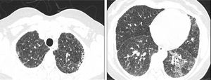 Tomografía de tórax de alta resolución de la paciente con hallazgos de enfermedad intersticial pulmonar (patrón de neumonía intersticial usual no clasificable). Distribución difusa de opacidades reticulares sin gradiente ápico-basal, micronódulos aleatorios en lóbulos superiores y bronquiolectasias.