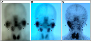 A) Glándulas parótidas y submaxilares de características gammagráficas normales. B) Signos gammagráficos de compromiso funcional en glándulas submandibulares caracterizado por disminución en la captación del radiofármaco. C) Signos gammagráficos de compromiso funcional severo de parótida unilateral sin captación del radiofármaco y glándulas submandibulares bilaterales, evidenciado por hipocaptación del radiofármaco.