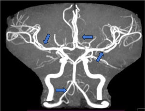 Imágenes por angiorresonancia magnética del cerebro del paciente: lesiones en banda en territorios de arterias cerebrales anteriores y medias bilaterales, con disminución de calibre en arteria vertebral derecha; compatibles todas con vasculitis de sistema nervioso central.