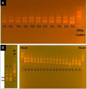 (A and B) Electrophoresis of Cdx2 rs11568820 vitamin D3 receptor gene polymorphism by (Tetra-primer ARMS–PCR) on 2% agarose gel. The size of the G allele=180bp, the A allele=245bp, and the internal control=370bp.