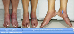 En los miembros inferiores se evidencia edema de las extremidades con presencia de macula eritemato-violácea y dorso de los pies necrosis de aspecto retiforme. De forma adicional, lesiones tipo ampollas tensas en plantas y dorso de pies.