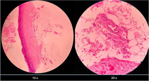 Biopsia cutánea de piel acral y de vaso mediano. Descripción de patología: dermis de aspecto usual, en hipodermis vasos de calibre mediano, con presencia de infiltración de pared con polimorfonucleares neutrófilos, sin necrosis fibrinoide asociada.