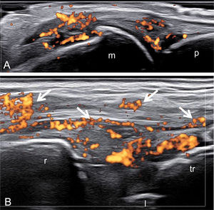 Psoriatic arthritis. A. Metacarpophalangeal joint. Active synovitis. B. VI compartment of the extensor tendons at wrist level. Active tenosynovitis of the extensor carpi ulnaris tendon (arrows). u=ulna; l=lunate bone; tr=triquetrum; m=metacarpal bone; p=proximal phalanx.