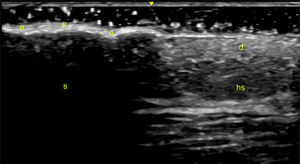 Psoriatic plaque. Sonographic image obtained using Logiq e US system with an 8–18i MHz linear transducer. Comparative image of the edge of a psoriatic plaque, distinguishing healthy skin (hs) from the plaque itself. Note the thickening of the epidermis (e), which generates an acoustic shadow (s), hindering the visualization of deeper structures. d=dermis.