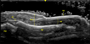 Healthy Nail (Longitudinal View): Sonographic image obtained using Logiq e US system with an 8–18i MHz linear transducer. The nail plates (np) appear as two parallel hyperechoic layers, separated by a hypoechoic interlaminar space. The nail matrix (nm) is visible as an isoechogenic structure located proximally, while the nail bed (nb) is shown as a hypoechoic area between the ventral nail plate and the periosteum of the distal phalanx (dp). The extensor tendon (et) inserts distally at the base of the dp. mp=middle phalanx.