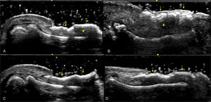 (A–D) Late Psoriatic Nail Changes (Longitudinal view). Sonographic image obtained using Logiq e US system with an 8–18i MHz linear transducer. Grayscale ultrasound reveals pronounced thickening of both the ventral and dorsal nail plates, resulting in the complete loss of the normal trilaminar structure characteristic of healthy nails. The nail plate appears as a single hyperechoic layer with inhomogeneous thickness (arrow), while the nail bed is significantly thickened (asterisk). In these advanced stages, the nail plate becomes thickened, wavy, and hyperechoic, exhibiting an overall inhomogeneous appearance.