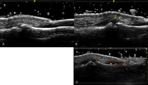 Enthesitis at the Distal Insertion of the Extensor Tendon. Sonographic image obtained using Logiq e US system with an 8–18i MHz linear transducer. Comparative ultrasound images of the extensor tendon at the distal insertion in the same phalanx of both hands. One hand demonstrates significant thickening and hypoechogenicity indicative of enthesitis (B), while the other hand shows no such findings (A). Additionally, the presence of intra-tendinous power Doppler signal in the affected hand is noted as a sign of active enthesitis (C).