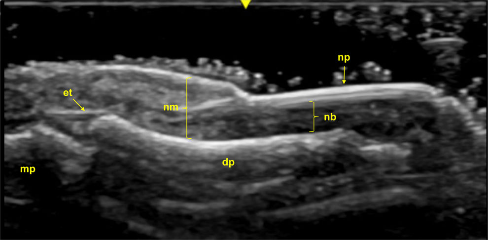 Update on ultrasound in spondyloarthritis and psoriatic arthritis ...