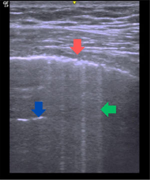 Lung ultrasound using a linear transducer. Red arrow: pleural irregularity. Blue arrow: A-line. Green arrow: B-line.