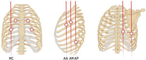 Simplified 14-point protocol for the assessment of interstitial lung disease in patients with autoimmunity. Examined points: 2nd intercostal space (ICS) – parasternal, 4th ICS – midclavicular (MC), 4th ICS – anterior axillary (AA), 4th ICS – midaxillary (AM), 8th ICS – posterior axillary (AP), 8th ICS – subscapular, 8th ICS – paravertebral. Each point is assessed bilaterally. Abbreviations: MC, midclavicular line; AP, posterior axillary line; AM, midaxillary line; AA, anterior axillary line; ICS, intercostal space.