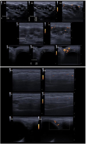 Ultrasound findings of salivary and lacrimal glands. Ultrasound findings of the salivary and lacrimal glands in the initial assessment and after pharmacological management. Panel (A) Right parotid gland. Evident heterogeneity in A.1. Anechoic patchy areas between 6mm and <15mm in A.2. Positive Doppler signal in A.3. Panel (B) Left submandibular gland. Evident heterogeneity and anechoic patchy areas between 6mm and <15mm in B.1. Positive Doppler signal in B.2. Panel (C) Left lacrimal gland. Evident heterogeneity in C.1. Anechoic patchy areas <6mm in C.2. Abundant Doppler signal in C.3. Panel (D) Right parotid gland after treatment. Parenchymal echogenicity similar to the thyroid in D.1. Mildly positive Doppler signal in D.2. Panel (E) Left submandibular gland after treatment. Parenchymal echogenicity similar to the thyroid, minimal heterogeneity with a hypoechoic area between 6 and 15mm in E.1. Mildly positive Doppler signal in E.2. Panel (F) Left lacrimal gland after treatment. Parenchymal echogenicity similar to the thyroid in F.1. Mildly positive Doppler signal in F.2.