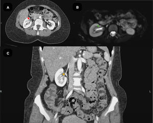 Abdominal magnetic resonance imaging (MRI) and computed tomography (CT). (A) Contrast-enhanced computed tomography (CT), axial view, demonstrating thickening of the right ureteral wall with enhancement (red arrow). (B) Magnetic resonance imaging (MRI), diffusion-weighted imaging (DWI) sequence, axial view, showing signal restriction consistent with active inflammation and tissue infiltration of the right ureter (green arrow). (C) Contrast-enhanced computed tomography (CT), coronal view, revealing mild hydronephrosis due to dilation of the right renal pelvis (orange asterisk).