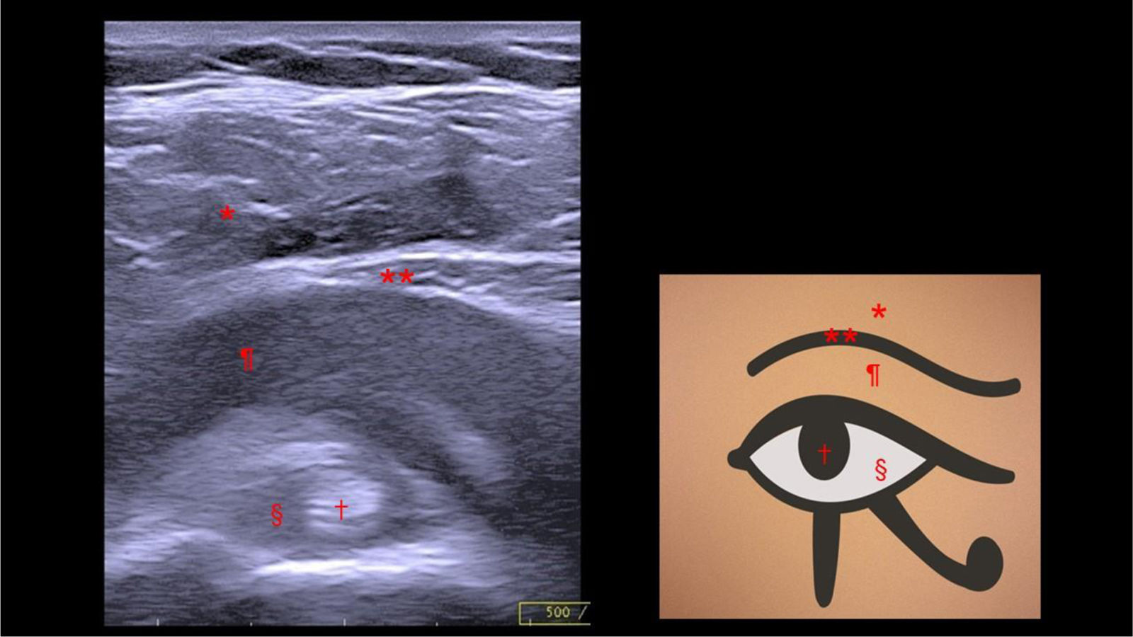 Polymyalgia Rhematica Eye “Eye of Horus” sign on ultrasound in a case of polymyalgia rheumatica