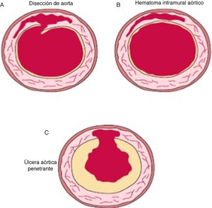 En la figura 2 se describe en forma gráfica las diferentes presentaciones del síndrome aórtico agudo. Esquema A. Disección de aorta, la cual se identifica por desgarro de la íntima. Esquema B. Hematoma intramural, el cual se identifica por la ausencia de lesión de la íntima con evidencia de colección hemática en la media arterial. Esquema C. Úlcera aórtica perforada, la cual se identifica por lesión aterosclerótica ulcerada en su centro, que penetra la íntima hasta la media. Fuente: Bonow R, Mann D, Zipes D, Libby P. Braunwald