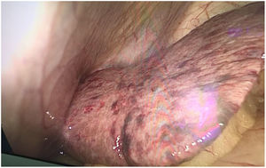 Hallazgos a la inspección laparoscópica 8 días después del inicio de los síntomas: se observa en el borde inferior del hígado la presencia de lesiones purpúricas y necróticas.