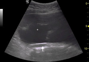 Sonda cónvex. Vista longitudinal abdominal. Se observa masa quística (asterisco) adyacente a la aorta abdominal (flecha), correspondiente con un cistoadenoma mucinoso de ovario. Ausencia de líquido libre intraperitoneal.