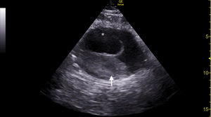Sonda cónvex. Vista transversal abdominal. Se observa dilatación de aorta (asterisco) con trombo intraaórtico reciente (flecha).