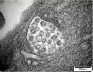 Microscopía electrónica: 15,000×. Presencia de vacuolas citoplasmáticas con inclusiones de morfología compatible con viriones de SARS CoV-2. Tomada de Kissling et al.38.