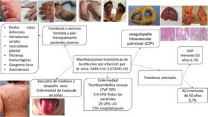Manifestaciones trombóticas de la infección por SARS-CoV-2. Adaptado Belen-Apak y Sarıalioğlu4. Fotografías obtenidas de Zhang et al.5 y Fox et al6.