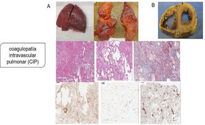 Coagulopatía intravascular pulmonar (CIP) en la infección por SARS-CoV-2. A) Pulmones macroscópicamente: edematosos con hemorragia irregular, con daño alveolar difuso y trombos de fibrina extensos en pequeños vasos y capilares distendidos; microscópicamente: membranas hialinas y hemorragia con trombos de fibrina presentes dentro de vasos y capilares dilatados con depósitos de fibrina extracelular extensa; agregaciones perivasculares de linfocitos, que fueron positivas para CD4 mayoritariamente y escasamente para CD8; presentación de numerosos megacariocitos teñidos con CD61 y el factor von Willebrand respalda aún más la hipótesis de la coagulación local es el factor principal de todo el proceso. B) Los hallazgos patológicos graves del corazón mostraron dilatación ventricular derecha extrema y esfuerzo del tabique interventricular como evidencia de insuficiencia cardíaca derecha causada por hipertensión pulmonar. Tomado de Fox et al.6.