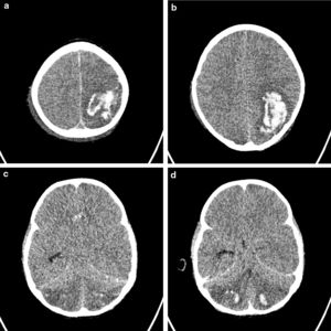 Tomografía axial computarizada cerebral.