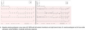 Electrocardiograms at admission. (A) Baseline electrocardiogram, sinus rate at 91 BPM with left anterior hemiblock and right branch block. (B) Electrocardiogram at 24h after admission, atrial fibrillation, moderate ventricular response.