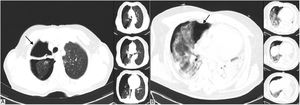 Visualización de TC torácica. 1A) Cambios fibrorretráctiles pleuro-parenquimatosos secuelares en el vértice pulmonar derecho; neumotórax derecho, con parcial colapso pulmonar homolateral. B) Extensas opacidades intercio-alveolares de distribución bilateral multisegmentaria, acompañada de neumotórax derecho de aproximadamente 40%.