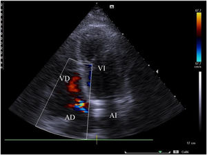 ECOTT con Doppler que demuestra insuficiencia mitral, FEVI: 35%, dilatación del ventrículo izquierdo y ambas aurículas.