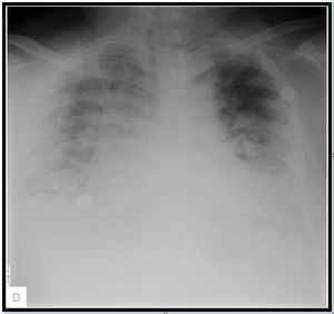 Radiografía de tórax. Se evidencia cambios bronquíticos pulmonares, radiodensidad basal bilateral de aspecto inflamatorio probablemente infeccioso por SARS-CoV 2 debido a contexto epidemiológico actual.