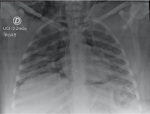 Radiografía de tórax portátil en la que se observa enfisema de tejidos blandos de región cervical. Líneas aéreas radiolúcidas que delimitan el contorno cardíaco y la continuidad de los diafragmas.