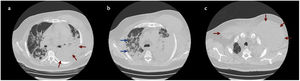 Tomografía simple en corte axial donde se observa la presencia de hemotórax izquierdo (2a), con áreas en vidrio esmerilado bilaterales en parénquima pulmonar indicativas de neumonía viral (2b), y la evidencia de gran hematoma que involucra tejido subcutáneo de la pared torácica de predomino izquierdo (2c).