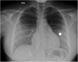 Radiografía de tórax. Obsérvese sobre el indicador un incremento de la densidad del parénquima pulmonar, asociado con broncograma aéreo.