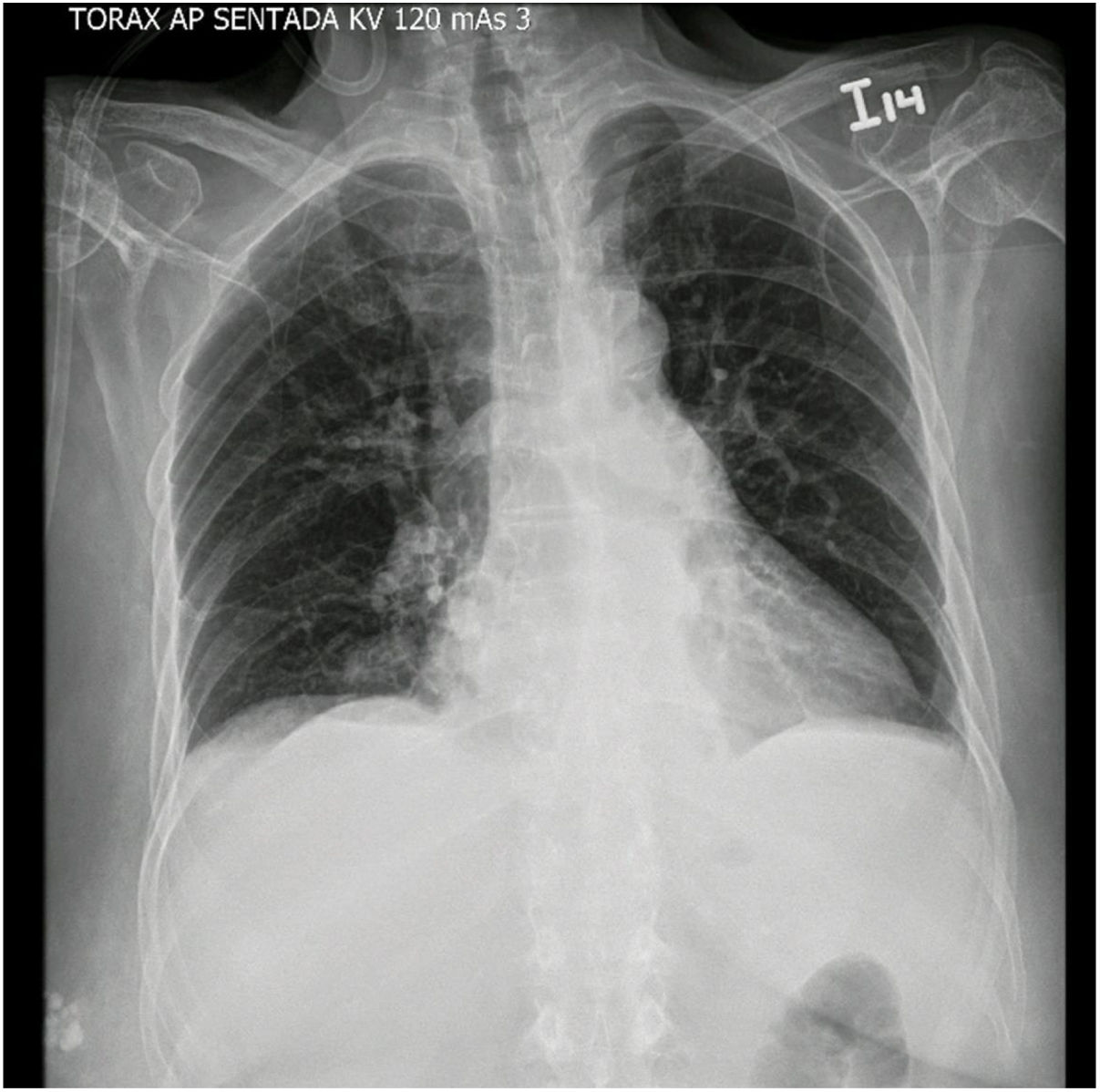 embolia pulmonar masiva