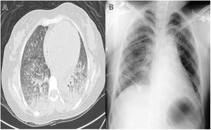 Chest computed tomography single phase and plain chest X-ray on post-ingestion days 7 (A) and 11 (B) respectively. Showed multiple micronodular and alveolar infiltrates disseminated of predominance toward the posterior regions of the basal lobes and bilaterally with areas of septal thickening.