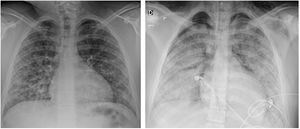 Radiografía de tórax realizada en decúbito supino. La imagen de la izquierda corresponde al día de su ingreso en la unidad de cuidados intensivos. La imagen de la derecha tras 24h de evolución.