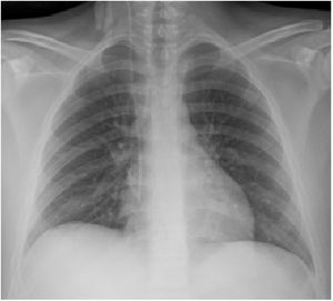 Radiografía de tórax postero-anterior, previa al alta hospitalaria.