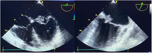 Ecocardiograma transesofágico en el cual se evidencia vegetación en válvula mitral de 12mm que compromete valva anterior y posterior.