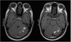 RNM cerebral con proyección T2 en la cual se evidencian pequeños hematomas intraparenquimatosos cerebelosos izquierdos y áreas de edema perilesional, en estadio subagudo.