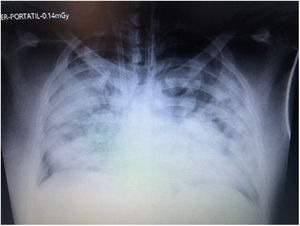 Radiografía de tórax. En la radiografía de tórax se observa compromiso de 4 cuadrantes, se evidencia cánula de entrega en vena yugular interna derecha.