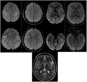 RMN cerebral con hiperintensidad de señal en T2/FLAIR cortical fronto-parietal bilateral simétrico respetando fibras en U, compromiso de núcleos de la base con afectación de talamos, núcleos lenticulares y caudados, los cuales restringen en la secuencia DWI. Hallazgos que se correlacionan con datos clínicos de hiponatremia severa y reposición de líquidos hipertónicos (desmielinización osmótica extrapontina).
