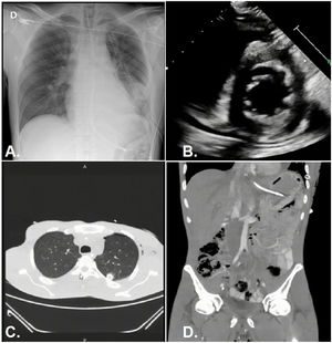 Imaging. (A) Post-thoracotomy AP chest X-ray: Left pneumothorax chamber in re-expansion with thoracostomy tube in proper position. (B) Post-cardiorrhaphy echocardiogram (report): impaired motility in the antero-septal–apical wall of the left ventricle, EF (ejection fraction) of 58%, mild dilation of the right ventricle, slight pericardial effusion. (C) Chest CT scan: coagulated hemothorax in the left lower lobe, posterior right basal pleural effusion with laminar free-flowing characteristics and passive atelectasis of underlying lung parenchyma, traumatic injury to the cardiac apex with minimal pericardial effusion, complete re-expansion of the left pneumothorax chamber with thoracostomy tube in proper position. (D) Contrast-enhanced abdominal CT scan: laceration in the lower renal pole with laminar distribution of perirenal, pararenal, left paracolic, and pelvic fluid. Extraluminal gas adjacent to the splenic–colonic angle.