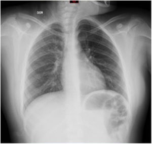 Rx de tórax. Sin evidencia de compromiso de parénquima pulmonar, sin derrame pleural. Rx: radiografía.