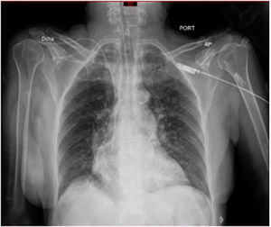 Rx de tórax. Sin hallazgos pulmonares o pleurales anormales. Rx: radiografía.