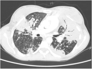 TC de tórax. Sin signos de tromboembolismo pulmonar, con hallazgos sugestivos de TB pulmonar. TB: tuberculosis; TC: tomografía computarizada.